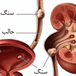 سنگ کلیه و مثانه