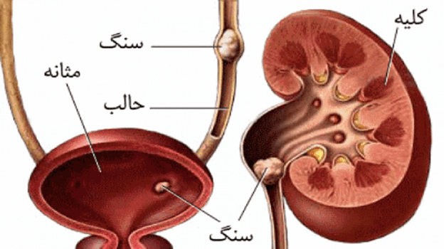 سنگ کلیه و مثانه